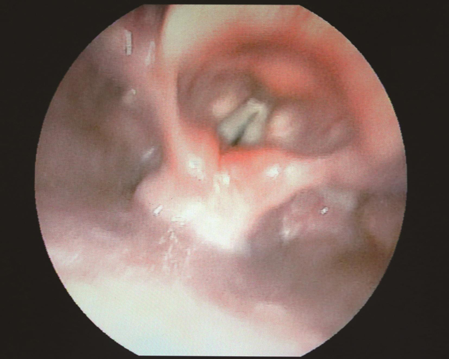 /uploads/image/2025-05-26/161411907图6 喉镜示声带闭合时裂隙.jpg 图6 喉镜示声带闭合时裂隙